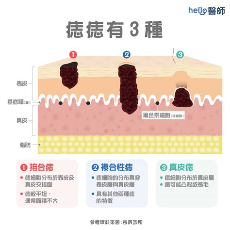 臉上長黑毛原因|痣變大、痣多或長毛會變皮膚癌？認識痣的形成與原因